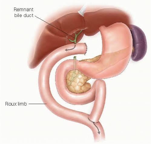 Biliary Bypass Procedures